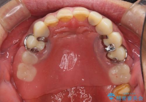 奥歯で物を噛めるようにしたい 入れ歯による咬合回復の治療中