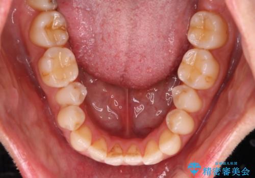 Invisalign インビザライン によるガタつき、受け口傾向の改善の治療前