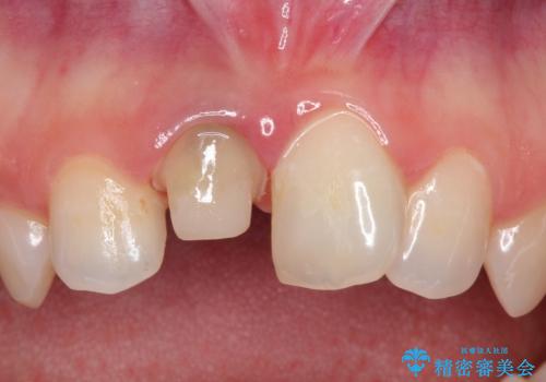前歯の治療。再根管治療~セラミッククラウンの治療中