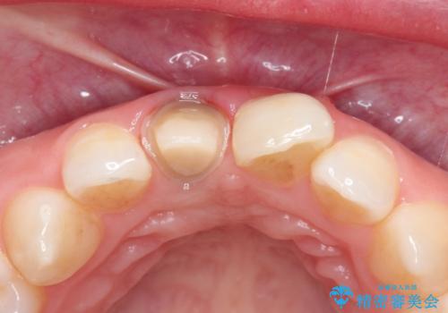 前歯の治療。再根管治療~セラミッククラウンの治療中