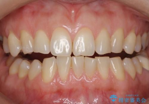 エクセレントホワイトニングで白くてきれいな歯に。の治療前