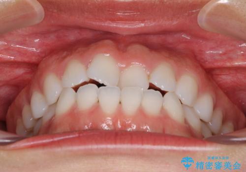 反対咬合を治したい インビザラインによる矯正治療の治療前