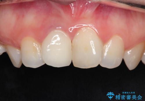 前歯の治療。再根管治療~セラミッククラウンの治療後