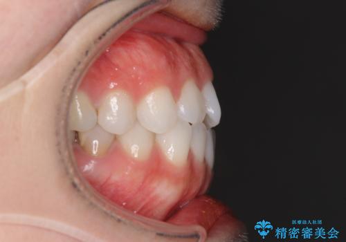 反対咬合を治したい インビザラインによる矯正治療の治療前