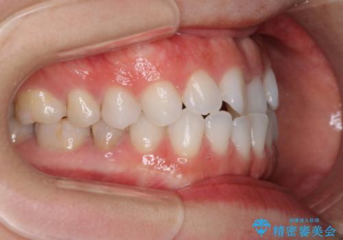 反対咬合を治したい インビザラインによる矯正治療の治療前