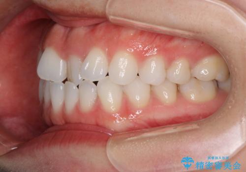 反対咬合を治したい インビザラインによる矯正治療の治療前