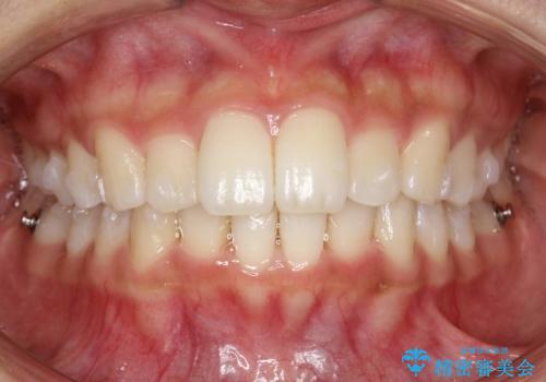 Invisalign インビザラインによる軽度なガタつきの改善の治療中