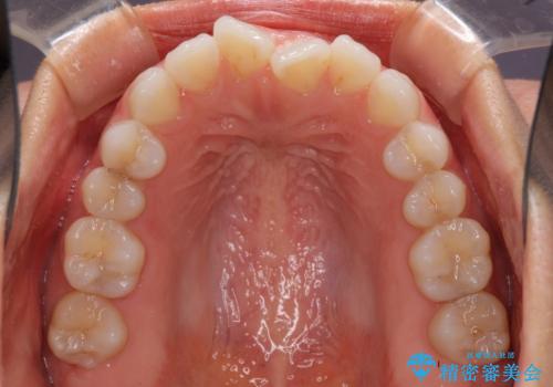 反対咬合を治したい インビザラインによる矯正治療の治療前