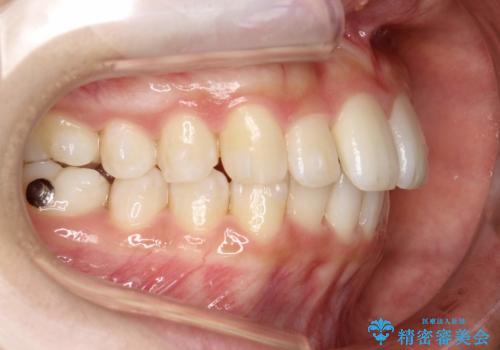 Invisalign インビザラインによる軽度なガタつきの改善の治療中