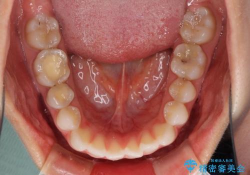 反対咬合を治したい インビザラインによる矯正治療の治療前