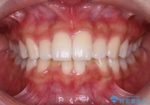Invisalign インビザラインによる軽度なガタつきの改善の治療前
