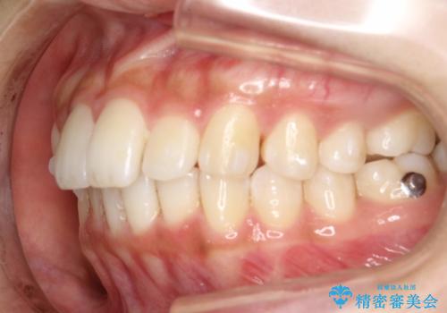 Invisalign インビザラインによる軽度なガタつきの改善の治療中