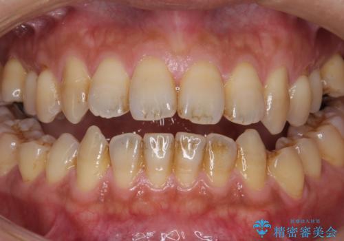 PMTCでステインを除去の症例 治療前