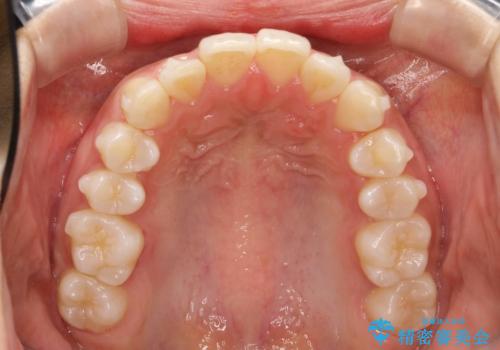 Invisalign インビザラインによる軽度なガタつきの改善の治療中
