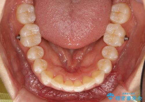 Invisalign インビザラインによる軽度なガタつきの改善の治療中