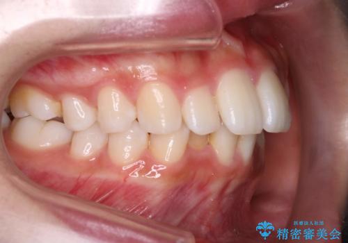 Invisalign インビザラインによる軽度なガタつきの改善の治療前
