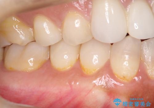 下がってしまった歯肉を元に戻したいが、自分の歯ぐきを移植するのは気が進まない : バイオマテリアルを応用した歯肉退縮への手術的対応の治療後