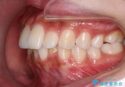 Invisalign インビザラインによる軽度なガタつきの改善の治療前