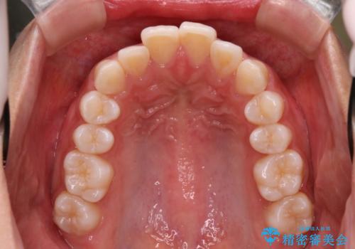 Invisalign インビザラインによる軽度なガタつきの改善の症例 治療前