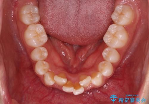 Invisalign インビザラインによる軽度なガタつきの改善の治療前