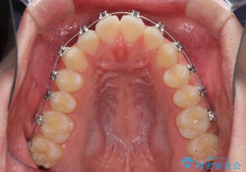 前歯のデコボコをワイヤー矯正で速やかに改善の治療中