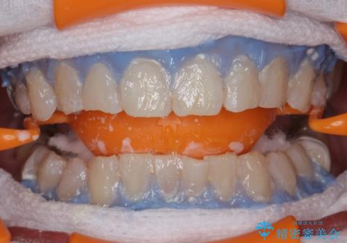 エクセレントホワイトニングで白くてきれいな歯に。の治療中