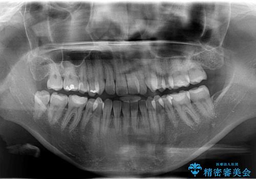 Invisalign インビザライン によるガタつき、受け口傾向の改善の治療前