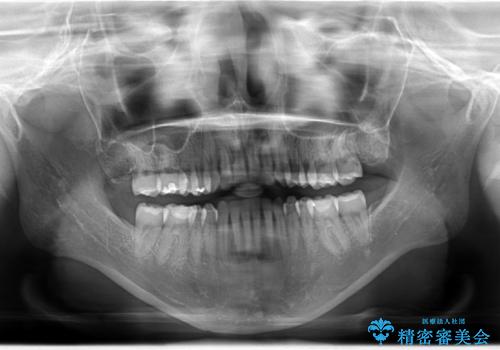 Invisalign インビザライン によるガタつき、受け口傾向の改善の治療後