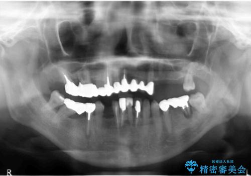 歯周病 全顎治療の治療前