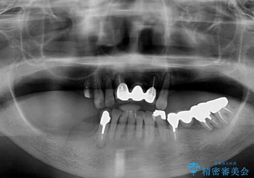 インプラントと入れ歯による全顎補綴治療の治療前
