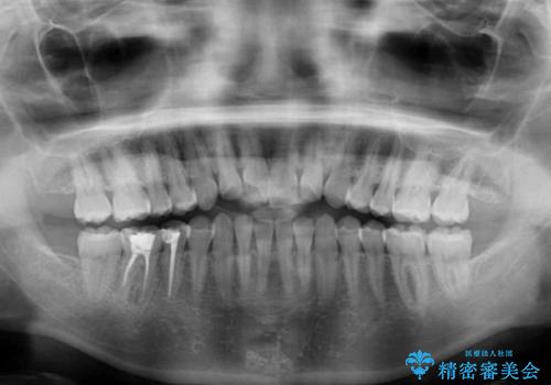 反対咬合を治したい インビザラインによる矯正治療の治療前
