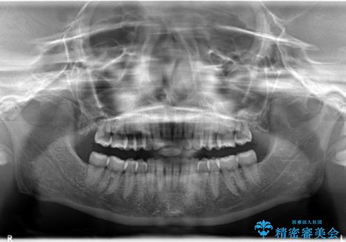 Invisalign インビザラインによる軽度なガタつきの改善の治療後