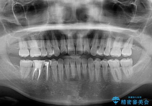 反対咬合を治したい インビザラインによる矯正治療の治療後