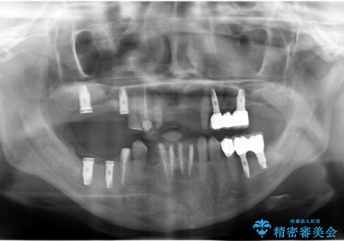 歯周病 全顎治療の治療中