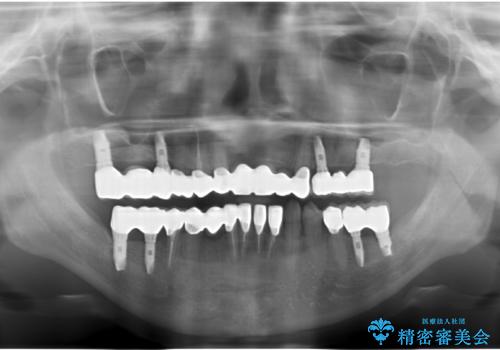 歯周病 全顎治療の治療後