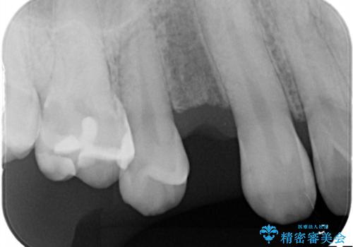 インプラントによる咬合回復の症例 治療前