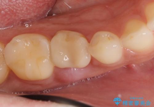 残せなくなってしまった乳歯 インプラントによる補綴の治療前