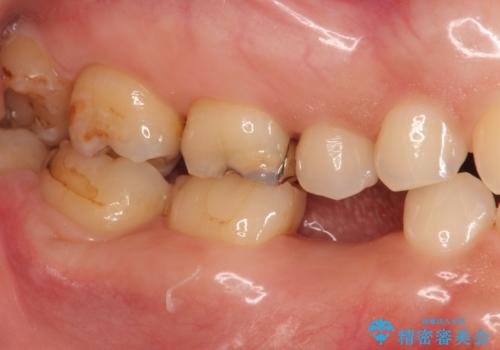 残せなくなってしまった乳歯 インプラントによる補綴の治療中