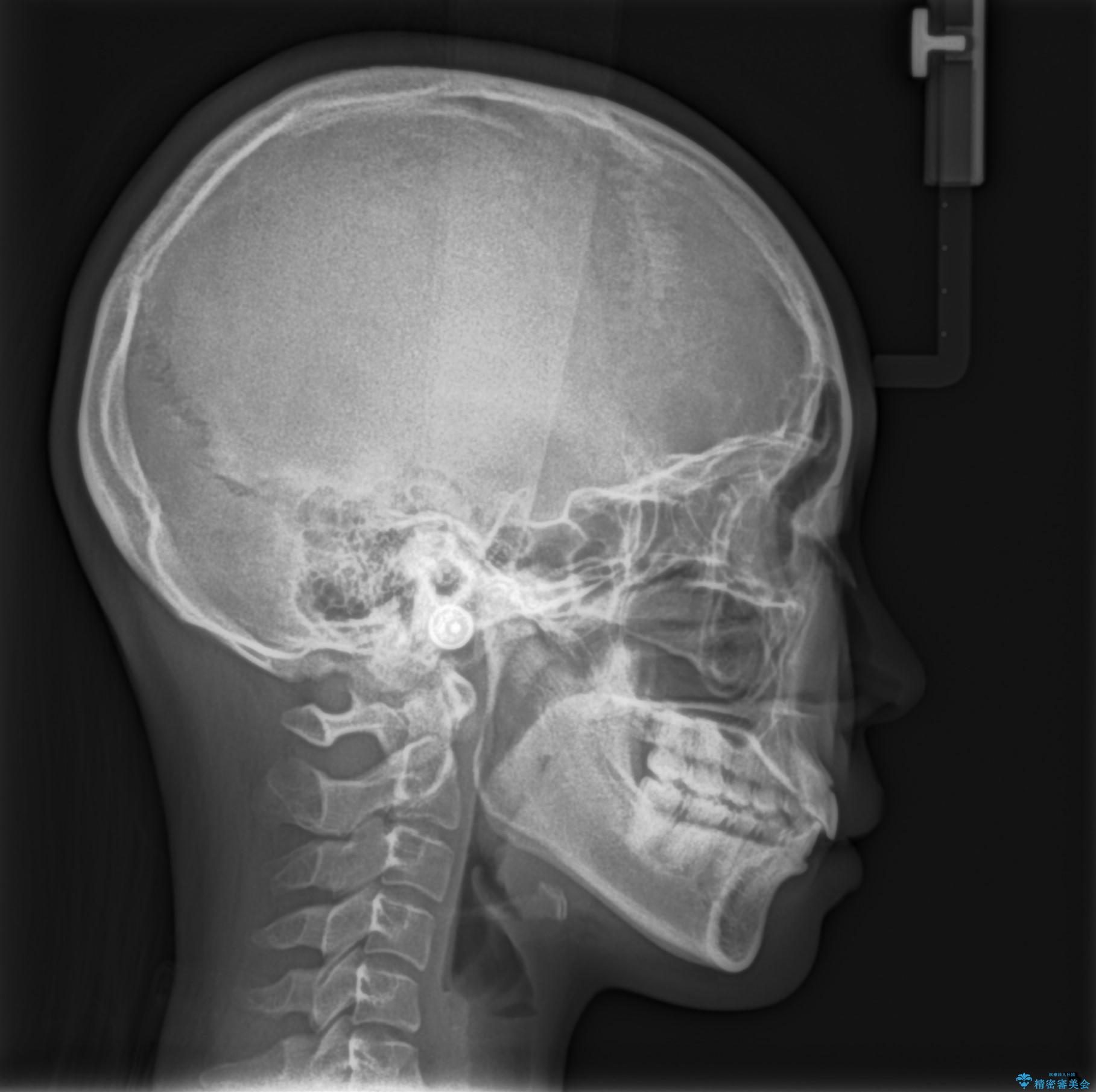 前歯の隙間を閉じたい。インビザラインによる治療の治療後(顔貌)