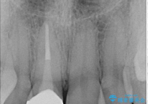 前歯の治療。再根管治療~セラミッククラウンの症例 治療後