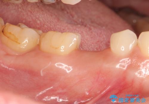 残せなくなってしまった乳歯 インプラントによる補綴の治療中