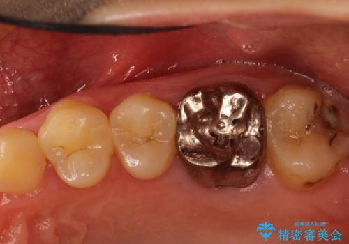 奥歯が割れてしまった! → インプラントによるかみ合わせの回復の症例 治療前