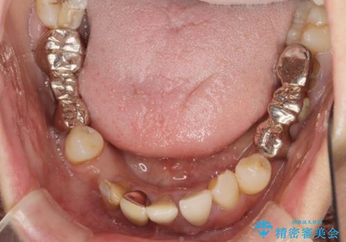 歯周病 全顎治療の治療前