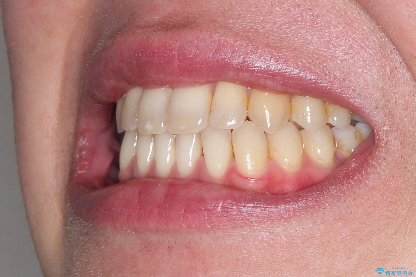 Invisalign インビザライン によるガタつき、受け口傾向の改善の治療後(顔貌)