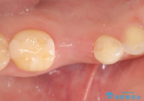 残せなくなってしまった乳歯 インプラントによる補綴の治療中