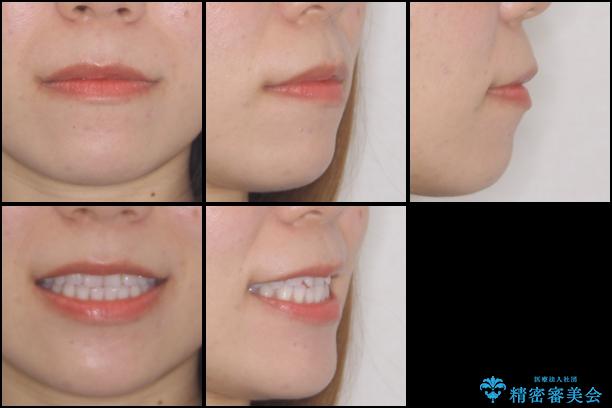 反対咬合を治したい インビザラインによる矯正治療の治療前(顔貌)