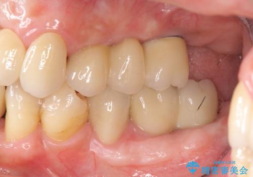 歯周病 全顎治療の治療後