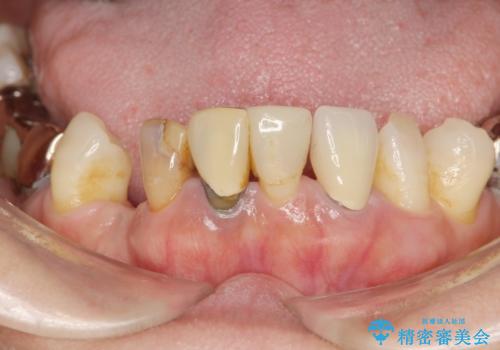 歯周病 全顎治療の治療前