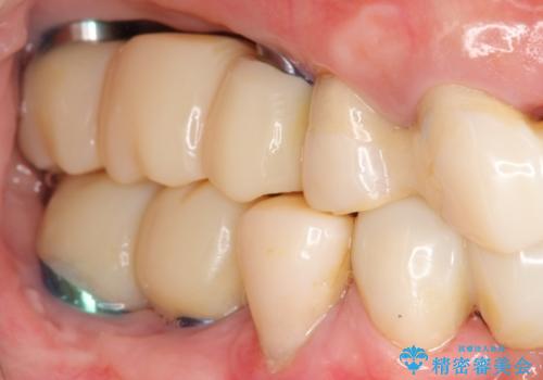 歯周病 全顎治療の治療中