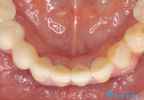 歯周病 全顎治療の治療後